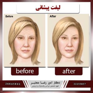لیفت-پیشانی-دکتر-معتبر