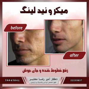 میکرونیدلینگ