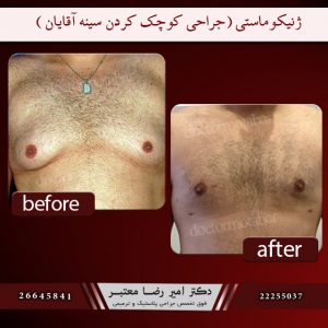 ژنیکوماستی