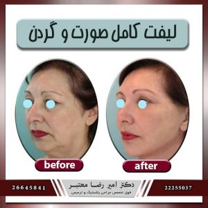 لیفت گردن