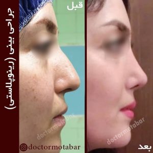 با عمل بینی تفاوت را در بینی به خوبی لمس کنید.