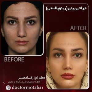 نمونه ای رینوپلاستی در خانمی 26 ساله