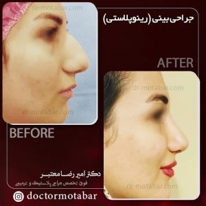 تصاویر قبل و بعد از راینوپلاستی در خانمی با هدف رفع قوز بینی