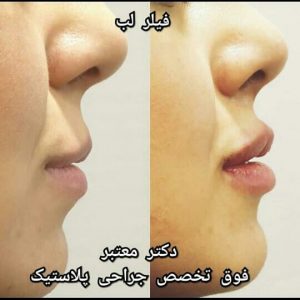 بجستگی لب ها