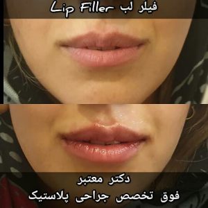 نمونه عمل زیبایی تزریق فیلر به لب