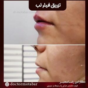 وارد کردن فیلر به لب