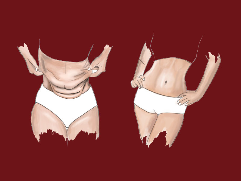 جراحی-ابدومینوپلاستی