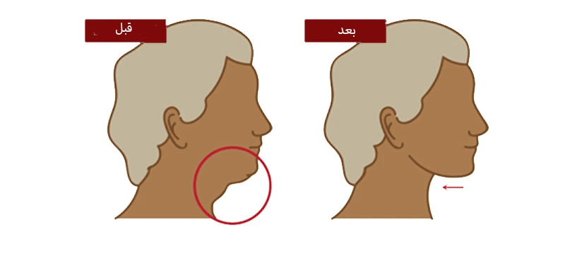 قبل و بعد از جراحی لیفت گردن
