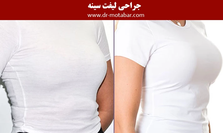 جراحی لیفت سینه