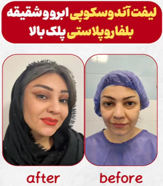 نمونه کار جراحی لیفت ابرو
