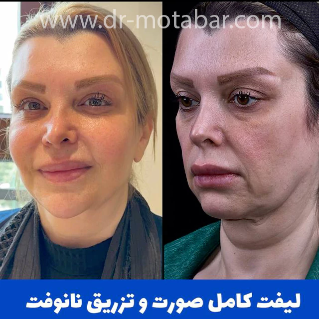 لیفت کامل صورت و تزریق نانوفت