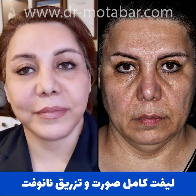 نمونه کار لیفت کامل صورت