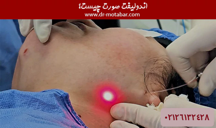 اندولیفت صورت چیست؟