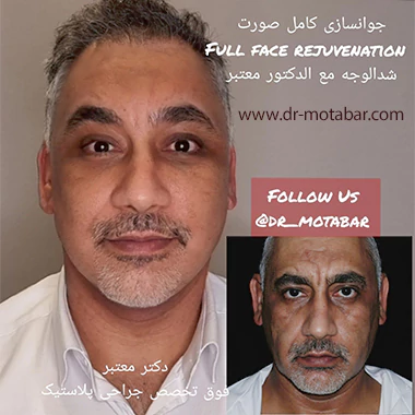 جراحی لیفت اندوسکوپی صورت