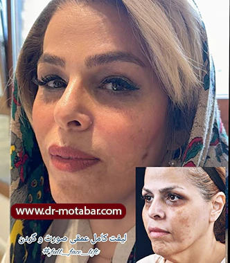 کاربردهای لیفت 360