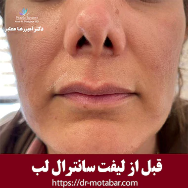 قبل از لیفت سانترال لب