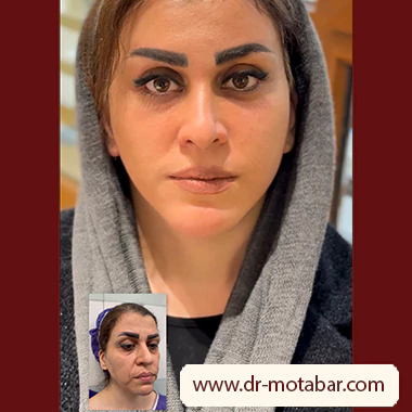 عکس لیفت هارمونیک صورت
