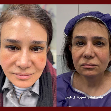 لیفت عمقی صورت و گردن