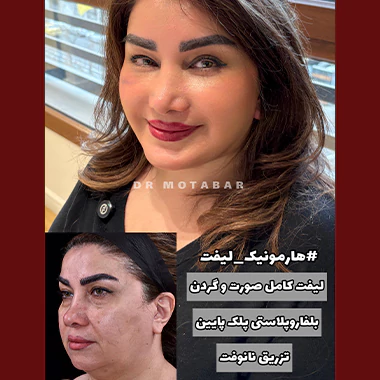 هارمونیک لیفت صورت