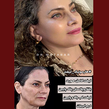 هارمونیک لیفت