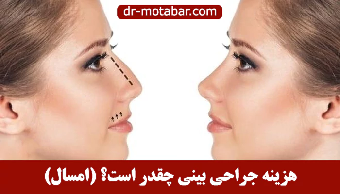 هزینه جراحی بینی (رینوپلاستی) در تهران چقدر است؟