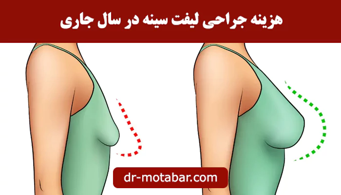 هزینه جراحی لیفت سینه در سال جاری